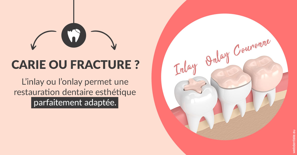 https://dr-bensoussan-jacques-yves.chirurgiens-dentistes.fr/T2 2023 - Carie ou fracture 2