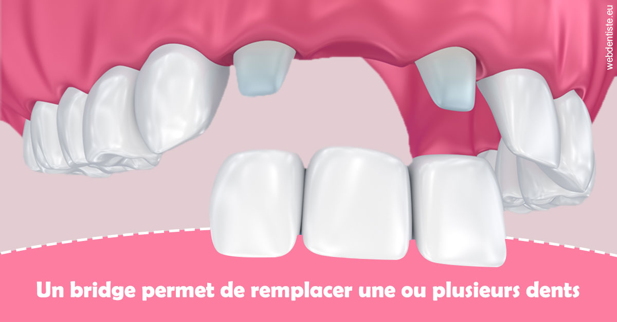 https://dr-bensoussan-jacques-yves.chirurgiens-dentistes.fr/Bridge remplacer dents 2