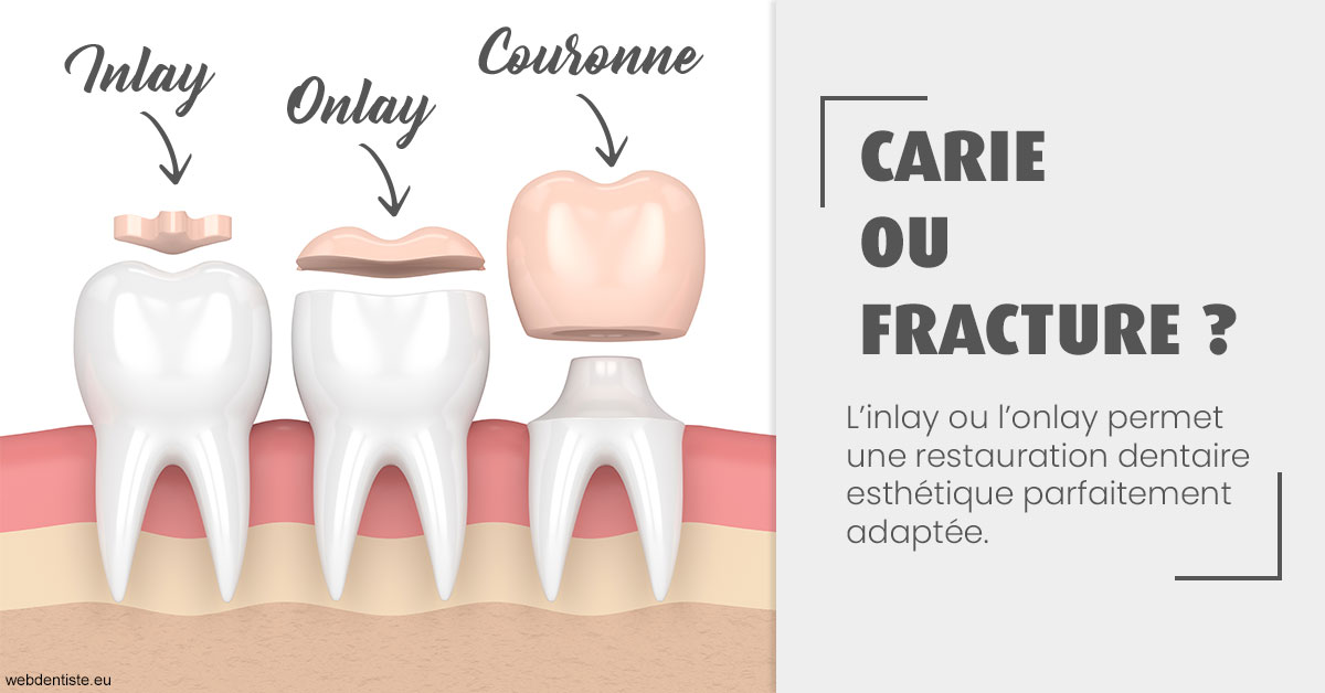 https://dr-bensoussan-jacques-yves.chirurgiens-dentistes.fr/T2 2023 - Carie ou fracture 1