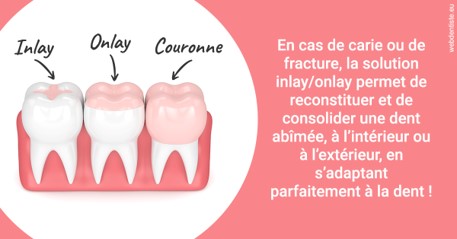 https://dr-bensoussan-jacques-yves.chirurgiens-dentistes.fr/L'INLAY ou l'ONLAY 2
