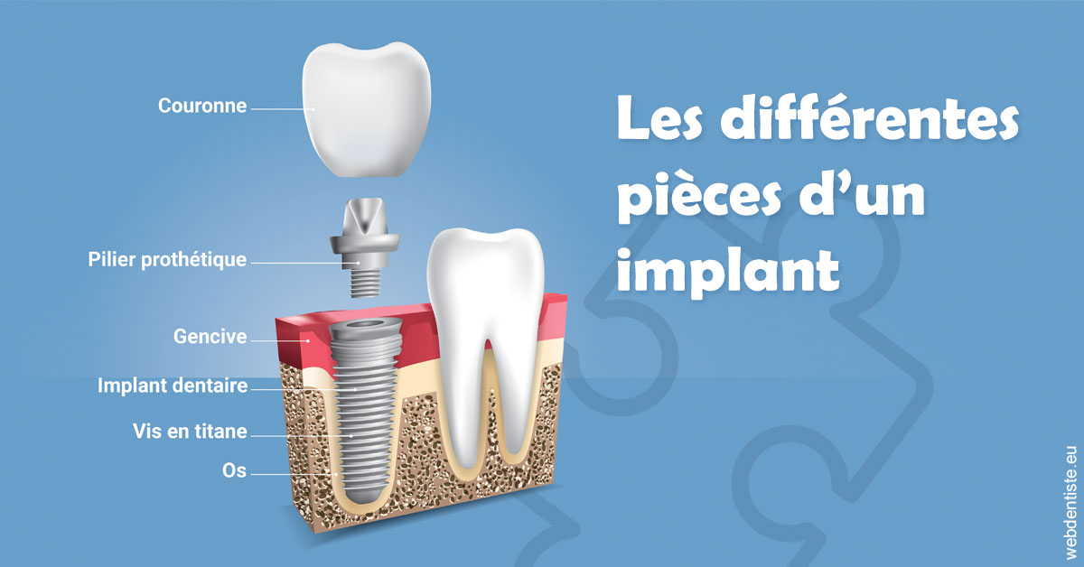 https://dr-bensoussan-jacques-yves.chirurgiens-dentistes.fr/Les différentes pièces d’un implant 1